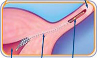 How to Have Essure Sterilization Reversed pics How to Have Essure Sterilization Reversed foto
