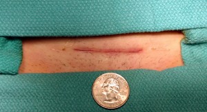 Essure can often be removed through a small incision.