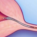 Essure-is-a-new-type-of-tubal-ligation