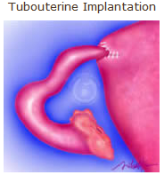 Tubouterine_Implantation