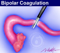 Tubal sterilization with bipolar coagulation forceps.