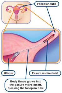 Essure is a mechanical device that blocks the fallopian tube at the uterus.