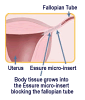 Essure-tubal-blockage-can-be-repaired