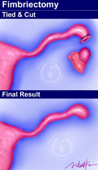 Fimbriectomy is removal of the fimbrial end of the fallopian tube.