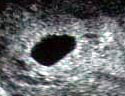 Intrauterine gestation sac after tubal reversal - vaginal US scan.