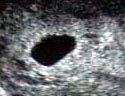 Intrauterine gestation sac seen on ultrasound examination.