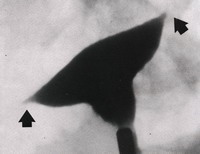 Tubal spasm often prevents x-ray dye from entering the fallopian tubes during an HSG.