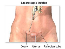 Diagnostic laparoscopy is useful in some cases prior to having a tubal reversal procedure.