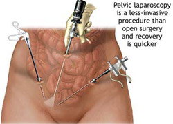 Laparoscopy can be performed before tubal reversal to assess the condition of the fallopian tubes.