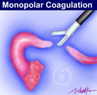 Tubal sterilization with monopolar coagulation forceps.