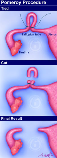 The Pomeroy operation is the most commonly performed tubal ligation method.