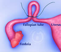 With the Pomeroy method of tubal ligation, part of the tube is elevated to create a loop or knuckle.