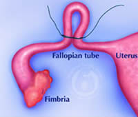 With the Pomeroy method of tubal ligation, part of the tube is elevated to create a loop or knuckle.