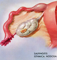 Salpingitis isthmica nodosa is a tubal abnormality sometimes found at tubal reversal surgery.