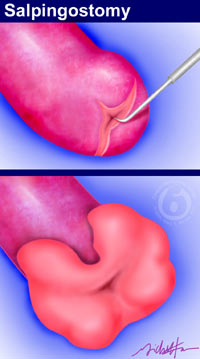 Dr. Berger performs tubal implantation by making an incision in the uterine muscle and introducing the tube into the uterine cavity.