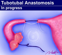 Dr. Berger performs tubal anastomosis by placing a stent in the tubal lumen bringing the 2 segments of fallopian tube together.