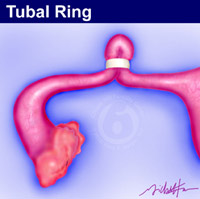 The falope ring is also called a tubal ring or tubal band.