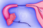 Microsurgical tubal anastomosis reattaches the tubal segments.