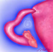 Tubouterine implantation inserts the separated fallopian tube into the uterus.