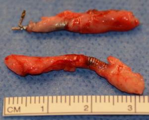 Intact removal of Essure intra-tubal inserts minimizes risk of fragmentation