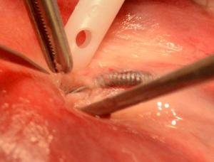 Essure-coil-removal-hemostasis