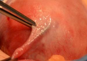 Essure-coil-removal-in-middle