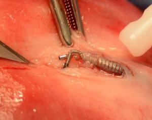 Essure-coil-removal-medial-aspect