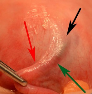 removing-essure-when-correctly-placed-in-fallopian-tube