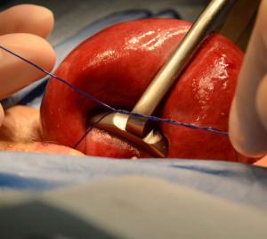 Applying-tourniquet-during-Essure-removal-surgery