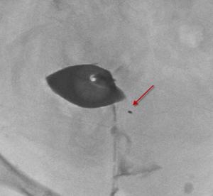 Essure can fragment during removal surgery.