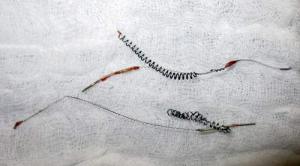 Removing-Essure-devices-is-more-difficult-after-tissue-in-growth-occurs