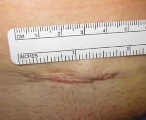 Essure-removal-skin-incision