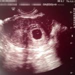 intrauterine-pregnancy-after-reversal-and-ablation