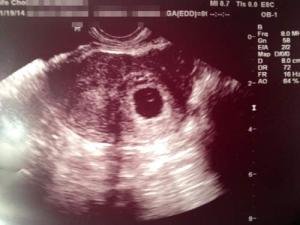 intrauterine-pregnancy-after-reversal-and-ablation