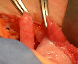 Tubal-segments-during-reversal-surgery