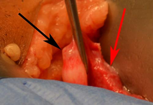 fallopian tubes surgery is affordable