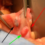 endometriosis and scar tissue after tubal coagulation