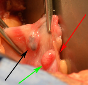 endometriosis and scar tissue from tubal ligation