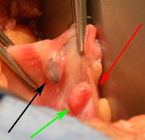 Laparoscopic Tubal Sterilization