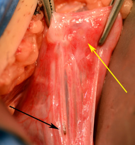 Difficult to see endometriosis after tubal ligation