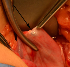 Endometriosis-inside-tube-after-a-tubal-ligation-procedure