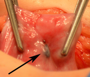 endometriosis-diagnoses-after-a-patients-tubes-were-tied