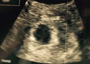 Ultrasound after tubal reversal showing pregnancy