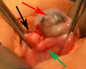 Scar tissue involving ovary and tube after tubal ligation