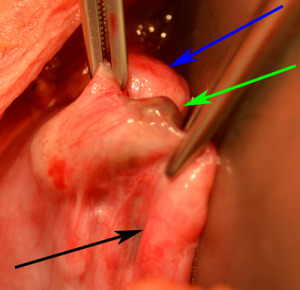 endometriosis caused by tubal clip