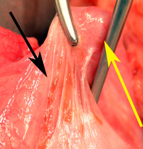 endometriosis-around-tube-after-tubes-tied