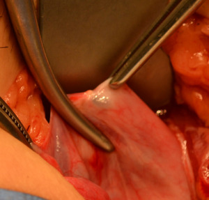tubal ligation pain caused by endometriosis