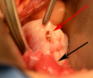 Could tubal ligation have caused this endometriosis on the ovary?