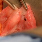 endometriosis after ligation and resection tubal ligation