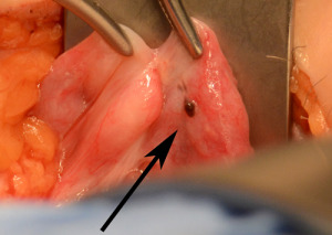 pigmented endometriosis involving fallopian tube after tubal ligation